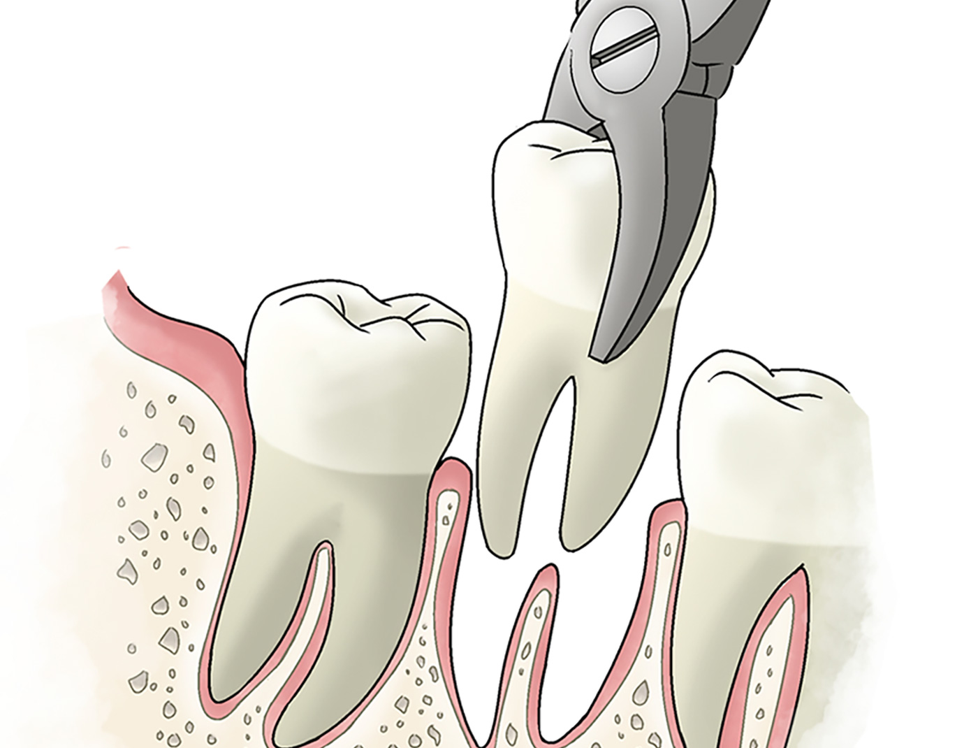 Tooth extraction. Выдергивание коренного зуба.
